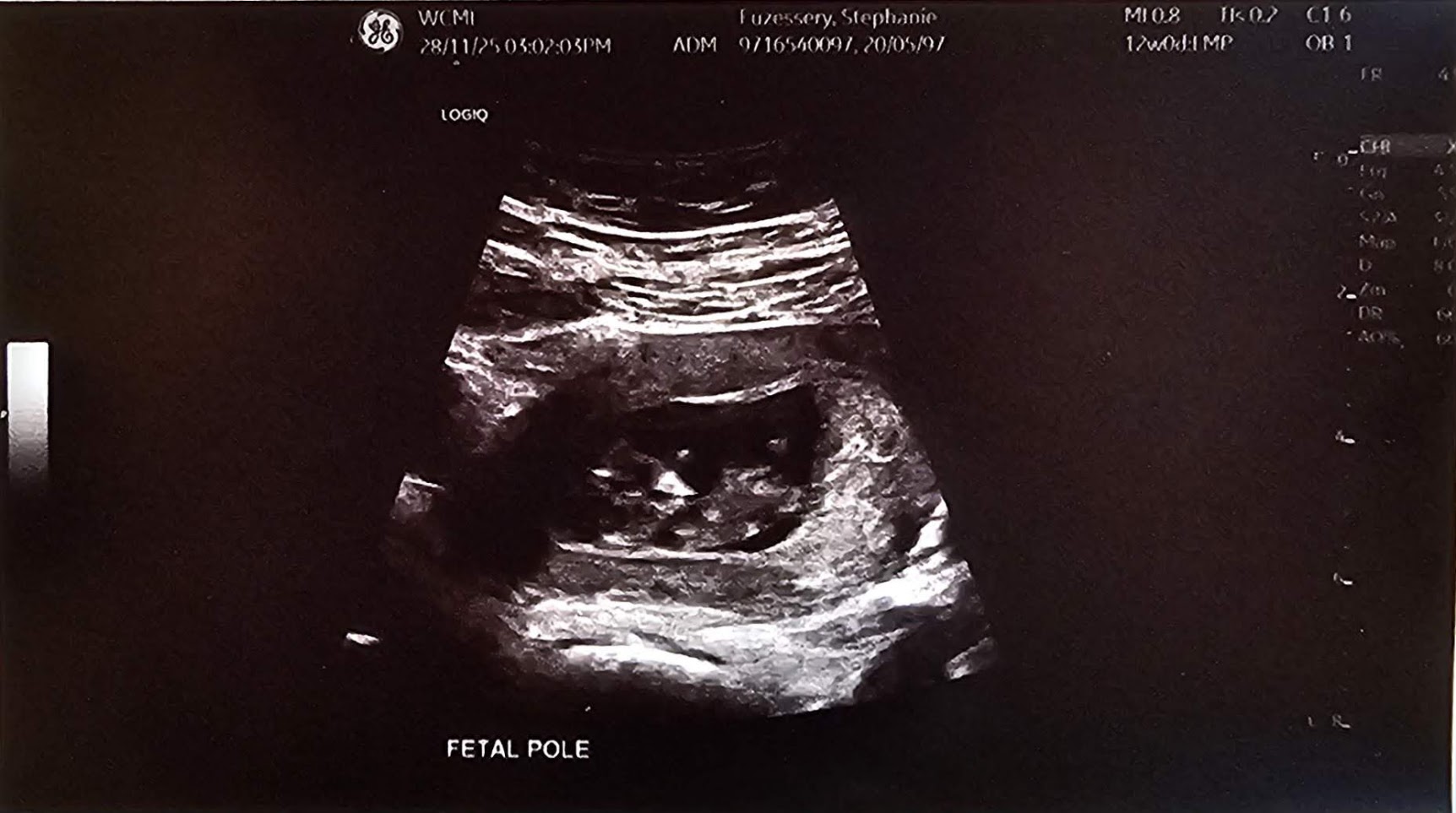 The baby's first ultrasound image